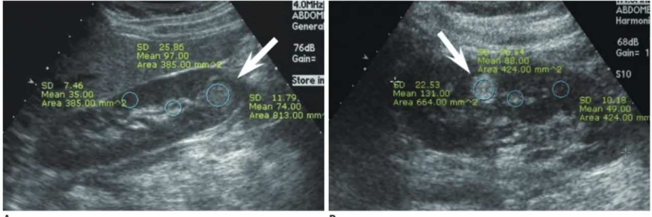 Fig. 1. Comparison of relative echogenicity between small renal cell carcinoma (RCC) and angiomyolipoma (AML) with minimal  fat.
