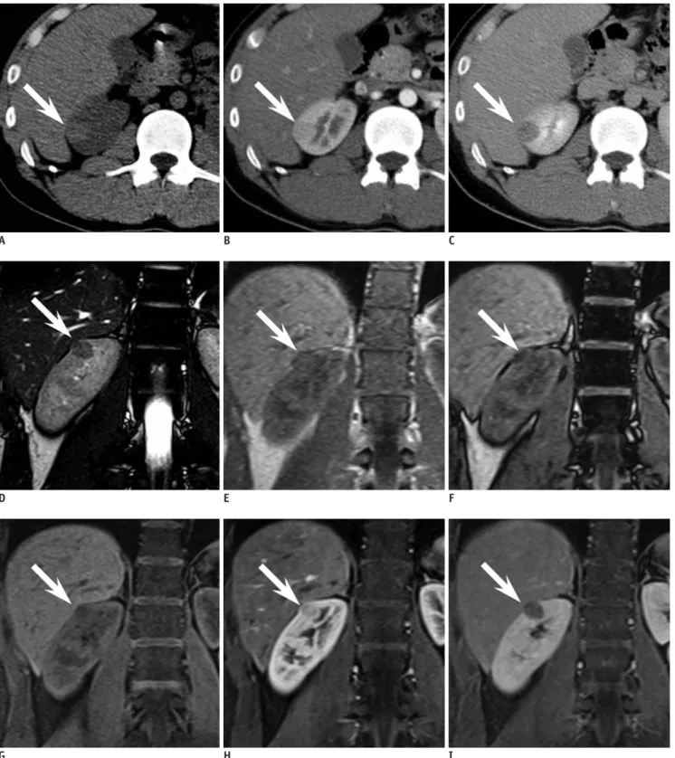 Fig. 2. 24-year-old man with small angiomyolipoma with minimal fat in right kidney demonstrating typical CT and MR findings.
