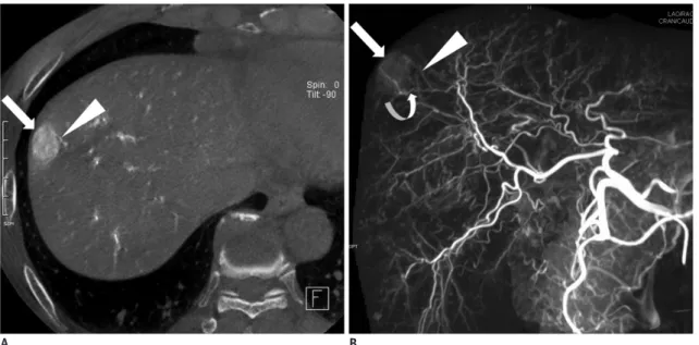Fig. 1. 60-year-old man with hepatocellular carcinoma.