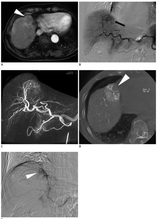 Fig. 5. 78-year-old man with hepatocellular carcinoma.