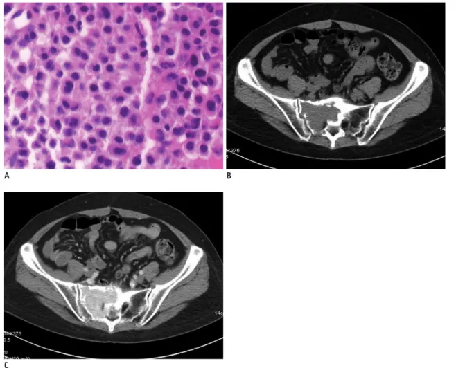 Fig. 1. Unilocular type solitary plasmacytoma in 58-year-old female (case 6). 