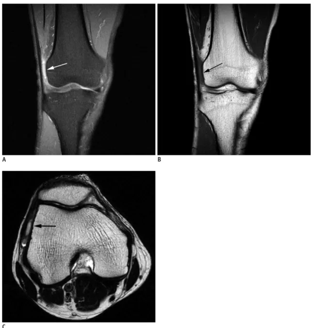 Fig. 1. 45-year-old male presented with recurrent lateral knee pain and movable nodule.