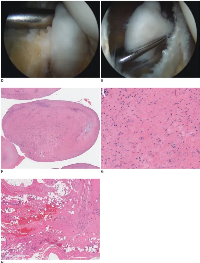 Fig. 1. 45-year-old male presented with recurrent lateral knee pain and movable nodule.