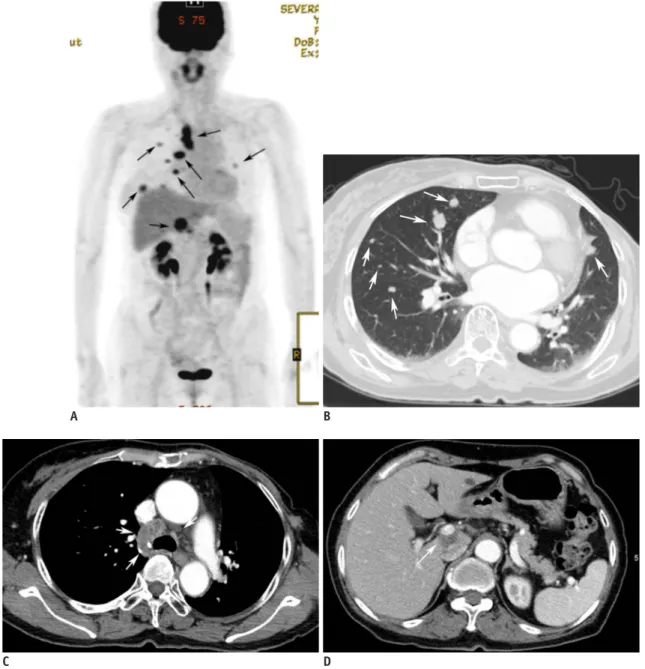 Fig. 3. 63-year-old woman who had undergone left mastectomy due to invasive ductal carcinoma