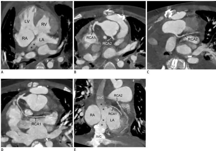 Fig. 2. 11-year-old boy who underwent double switch operation for congenitally-corrected TGA.