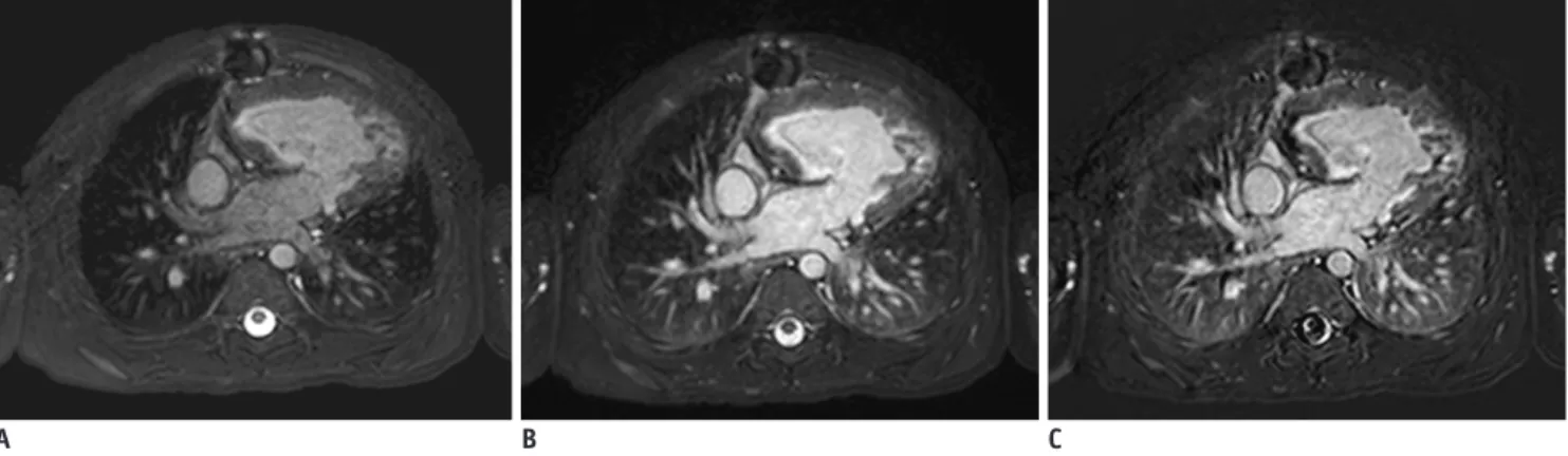 Fig. 4. 3-year-old boy with functional single ventricle who underwent extracardiac conduit Fontan operation.