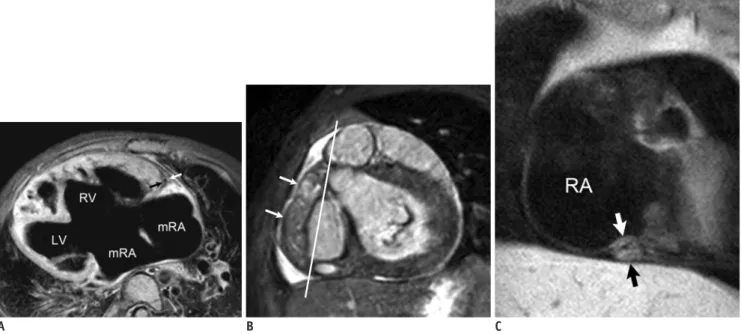 Fig. 6. Coronary vessel wall MRI.
