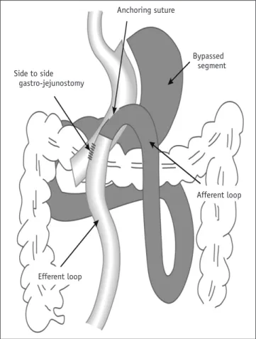 Fig. 1. Illustration of laparoscopic mini-gastric bypass.  Mini- Mini-gastric tube is mounted parallel from angle of His to 2 cm proximal  to pylorus along lesser curvature