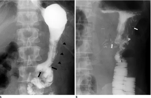 Fig. 2. Normal upper gastrointestinal series on postoperative day 1.