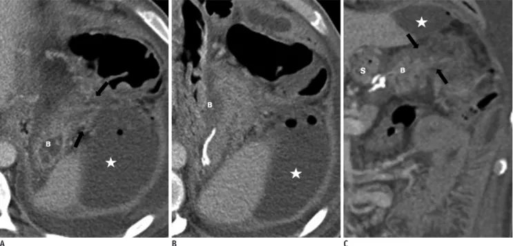Fig. 12. Spontaneous perforation in bypassed segment of 39-year-old man with generalized abdominal pain 8 months after surgery.