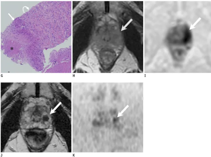Fig. 1. 75-year-old man after Bacillus Calmette-Guérin immunotherapy for bladder carcinoma.