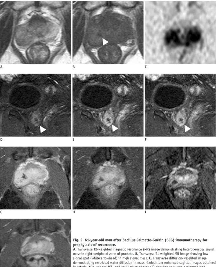 Fig. 2. 61-year-old man after Bacillus Calmette-Guérin (BCG) immunotherapy for  prophylaxis of recurrence.
