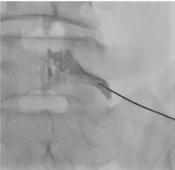 Fig. 2. 76-year-old female with low back pain and left sciatica. 