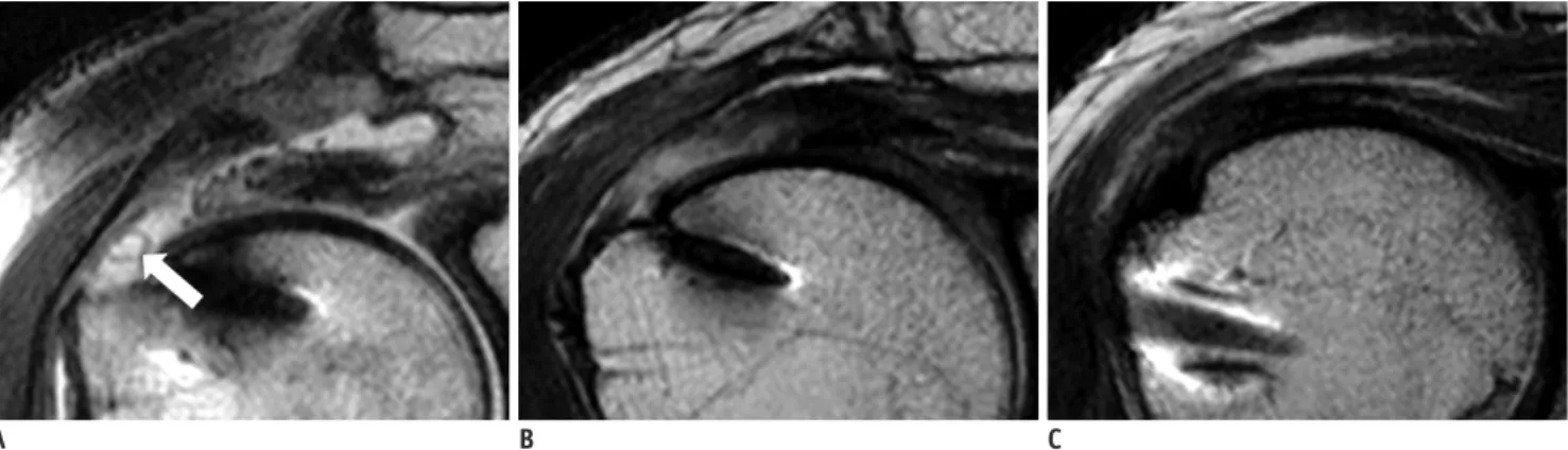 Table 1. Patterns of Signal Intensity and Interval Changes in Repaired Tendons on T2-Weighted MR Images