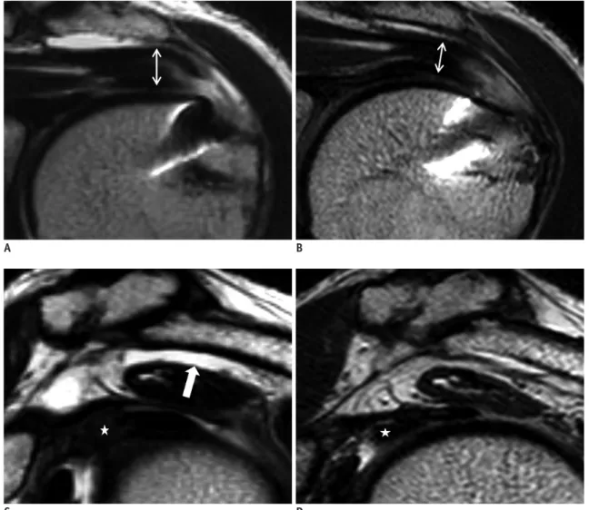 Fig. 5. 52-year-old man with repaired tendon that changed from type I to type II during follow-up period, with decreased  subacromial fluid and edema of rotator cuff interval