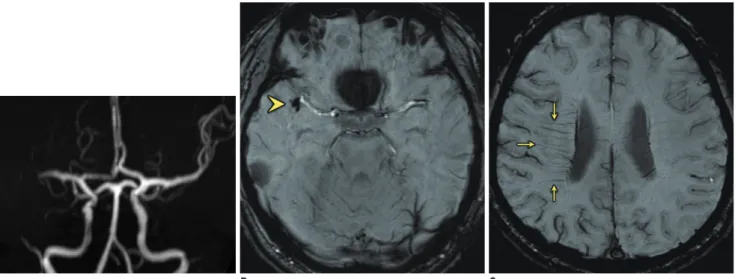 Fig. 5. Signs of clot and transmedullary vein involvement on susceptibility-weighted imaging (SWI) in patient with occlusion in  right M1 segment.