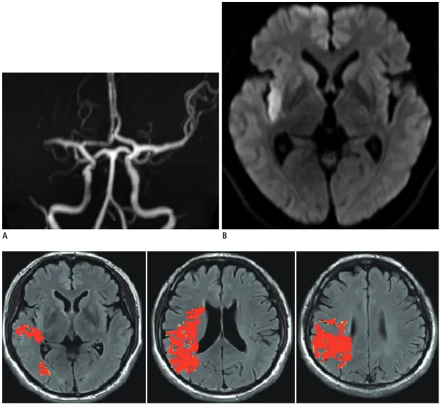 Fig. 6. Favorable diffusion-weighted imaging-perfusion-weighted imaging (DWI-PWI) mismatch pattern (large penumbra with  small infarct).