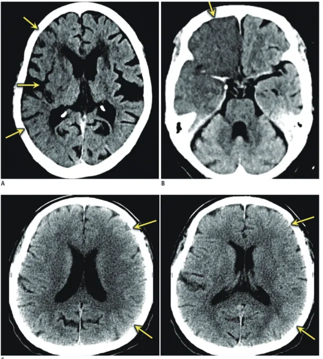Fig. 1. Early ischemic changes on unenhanced head CT (3 different patients).