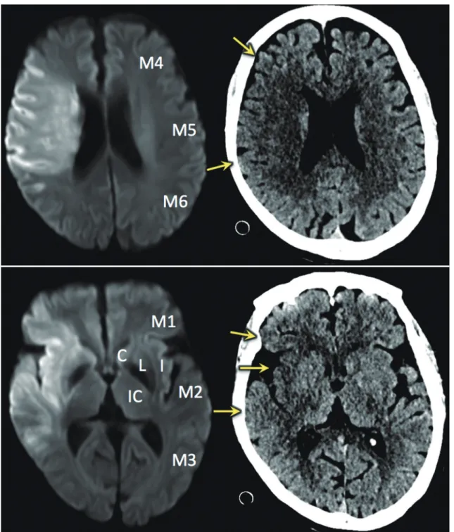 Fig. 2. Alberta Stroke Program Early CT (ASPECT) Score.  ASPECT scoring system is applied to both unenhanced CT and diffusion-