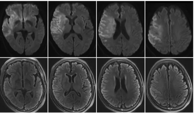 Fig. 3. Diffusion-weighted imaging (DWI) and fluid-attenuated inversion recovery (FLAIR) mismatch in 76-year-old female