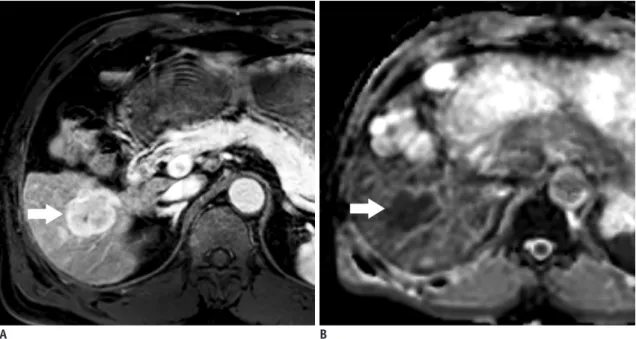 Fig. 9. 63-year-old man with HCC showing restricted diffusion.