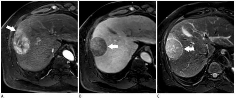Fig. 1. 55-year-old man with encapsulated progressed HCC.