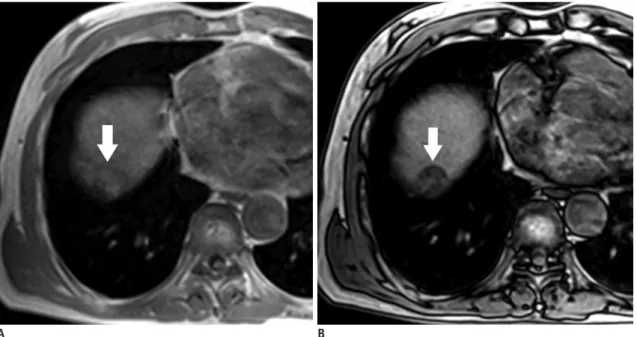Fig. 2. 76-year-old man with fat-containing HCC.