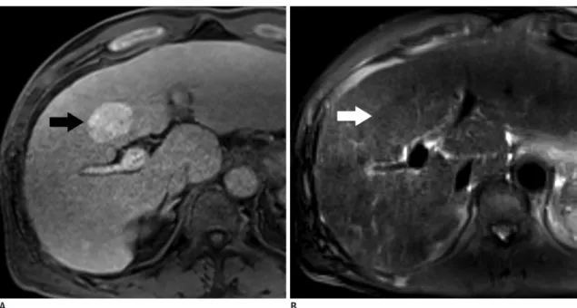 Fig. 3. 71-year-old man with HCC showing T1 hyperintensity.