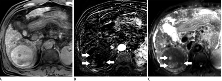 Fig. 4. 56-year-old man with HCC showing nodule-in-nodule appearance.