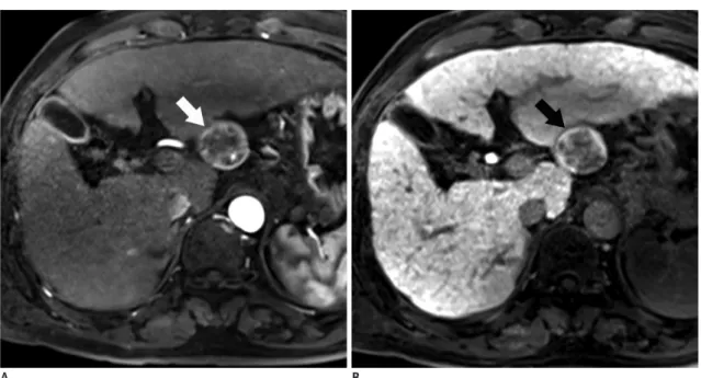 Fig. 7. 64-year-old man with HCC showing hyperintensity in hepatobiliary phase.