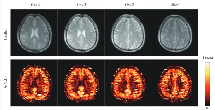 Fig. 4. Baseline and cerebral blood flow images of brain and were acquired using three-dimensional pseudo-continuous arterial  spin labeling technique with balanced steady-state free precession readout scheme