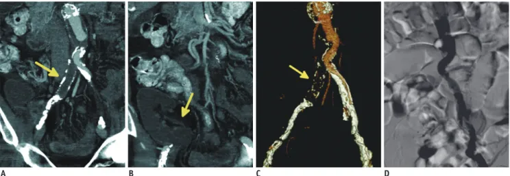 Fig. 8. 70-year-old male is shown, who previously was surgically treated for large aortic aneurysm with aorto-iliac graft