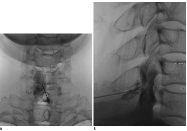 Fig. 2. 41-year-old man with left shoulder pain for duration of 3 months, due to neural foraminal stenosis.