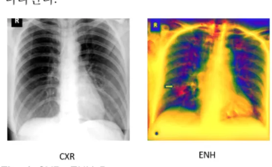 Fig.  1  CXR,  ENH  Data