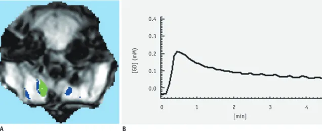 Fig. 1. Selection of arterial input function (AIF) for analysis of permeability parameters.