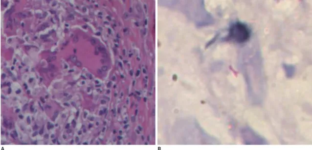 Table 1. MR Findings of Patients with Prostate Tuberculosis