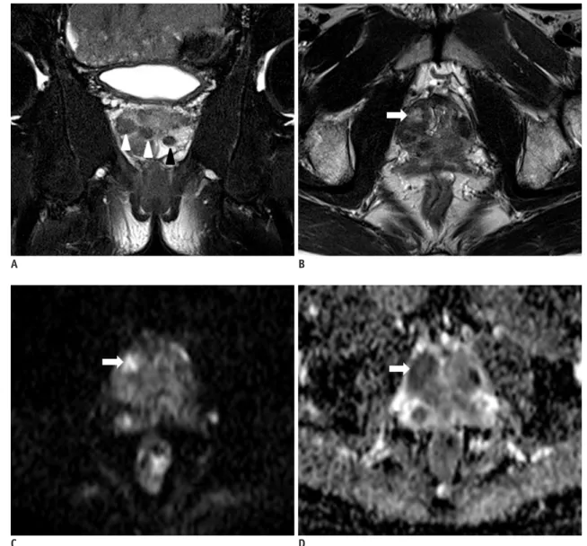Fig. 3. Nodular type prostate tuberculosis in 48-year-old man.