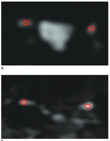 Fig. 2. 50-year-old female patient with right-sided sciatica.