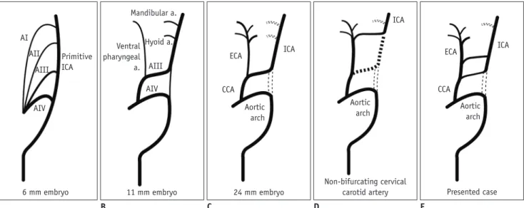 Fig. 3. Schematic illustration of presented case in comparison with normal ICA-ECA development and non-bifurcating cervical  carotid artery.
