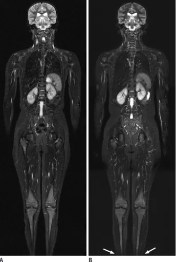 Fig. 2. 11-year-old girl with Ewing sarcoma of cervical spine.