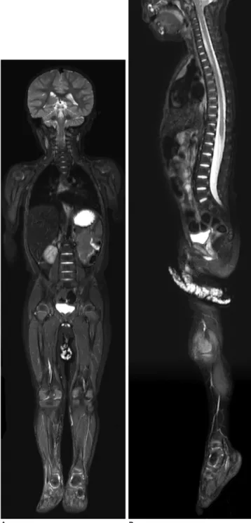 Fig. 3. 2-year-old boy with infantile fibrosarcoma at  craniocervical junction.