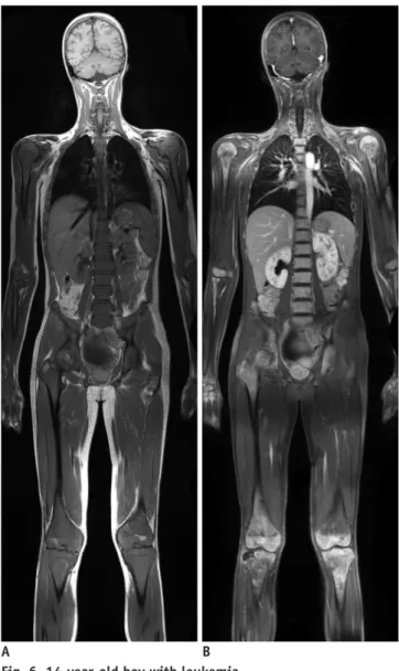 Fig. 7. 4-year-old boy with B-cell lymphoma.