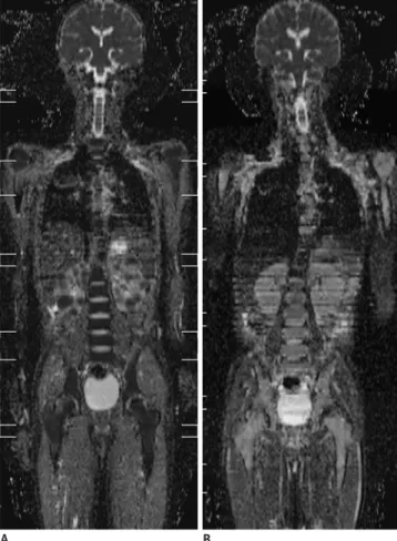 Fig. 8. 10-year-old boy with Burkitt lymphoma.