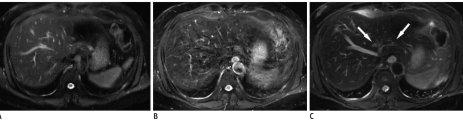 Fig. 1. 57-year-old man diagnosed with colon cancer with liver metastasis. 