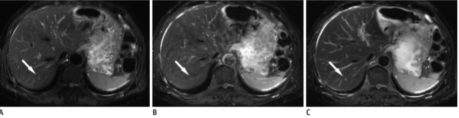 Fig. 3. 60-year-old man diagnosed with colon cancer with liver metastasis. 