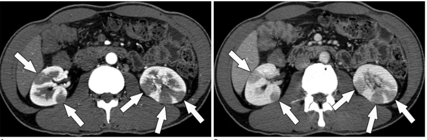 Fig. 2. 49-year-old man with IgG4-KD manifesting as multiple, renal parenchymal nodules.