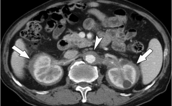 Fig. 9. Response of IgG4-KD to steroid therapy in 72-year-old man.