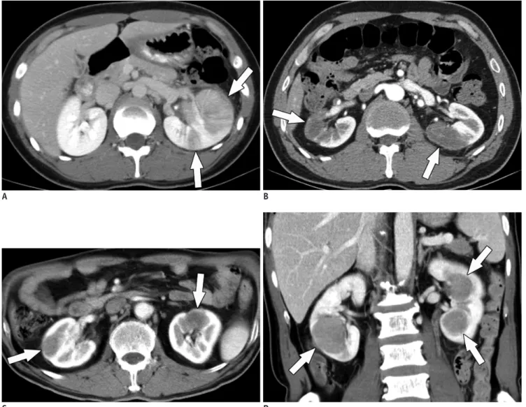 Fig. 10. Mimickers of IgG4-KD manifesting as multiple, renal parenchymal lesions.