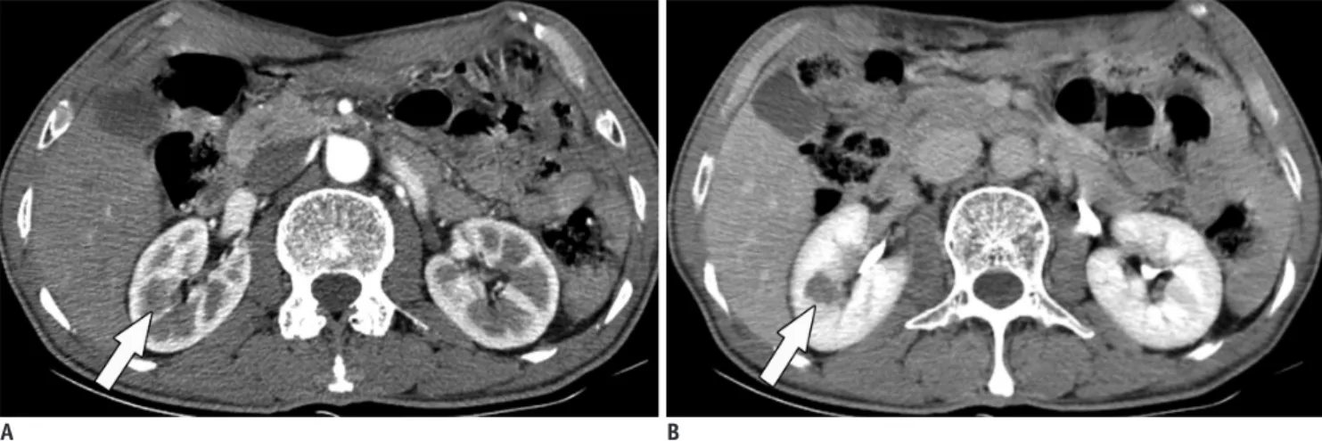 Fig. 11. Mimicker of IgG4-KD manifesting as single parenchymal nodule.