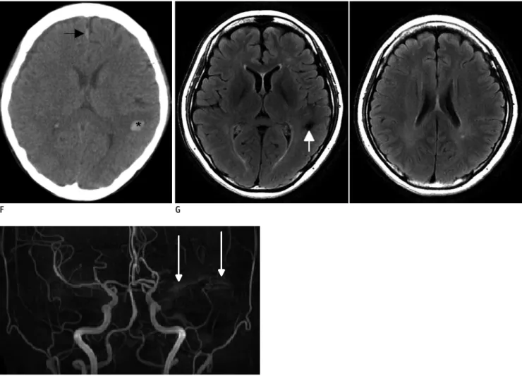 Fig. 1. Unilateral posterior reversible encephalopathy syndrome in 49-year-old woman with acute renal failure who had history of  lung transplantation and of taking tacrolimus.